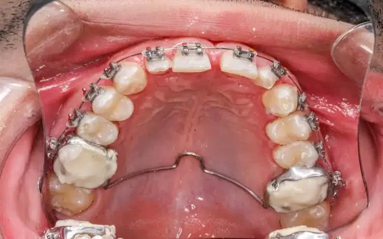 The Art of Expanding Smiles: Understanding the Palate Expander