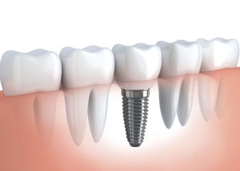 Evaluating the Efficacy of Bredent BlueSKY™ Implants in Immediate Loading Cases for Atrophic Edentulous Maxillae