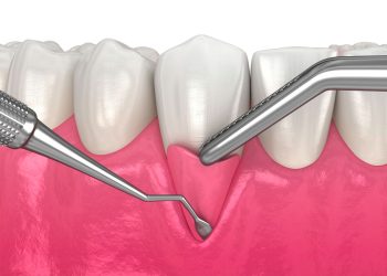 The Evolving Role of Free Gingival Graft in Dental Practices
