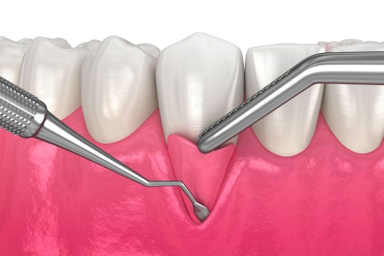 The Evolving Role of Free Gingival Graft in Dental Practices