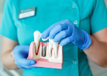 The Art of Dental Implant Care: Preventing Peri-Implantitis