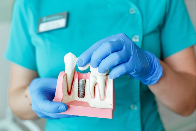 The Art of Dental Implant Care: Preventing Peri-Implantitis