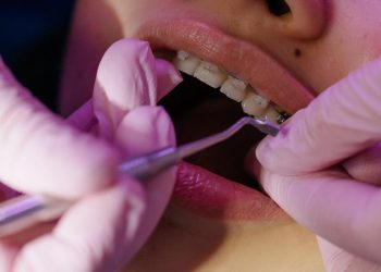 Can Cosmetic Dentistry Help with Tooth Alignment Without Braces?