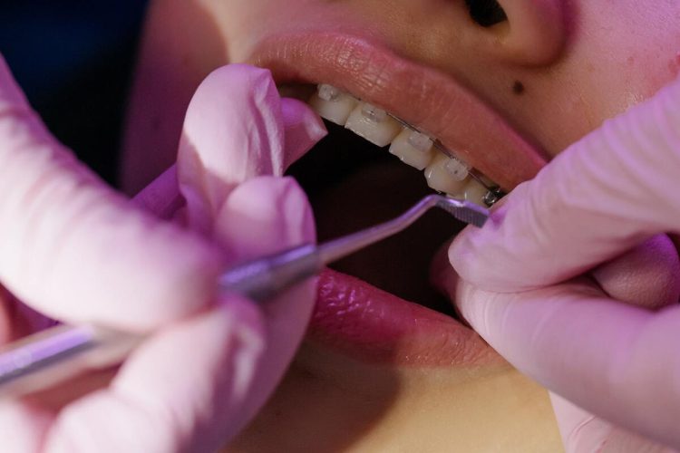 Can Cosmetic Dentistry Help with Tooth Alignment Without Braces?