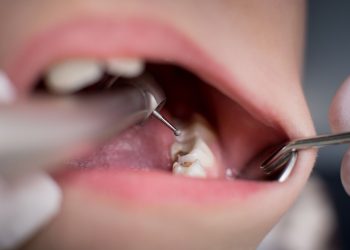 What are the Risk Factors for Oral Cancer? How Can I Reduce the Chance of Getting Oral Cancer?