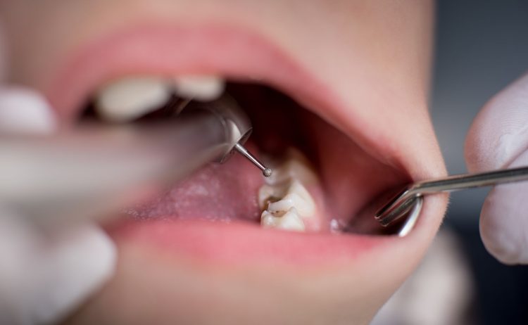 What are the Risk Factors for Oral Cancer? How Can I Reduce the Chance of Getting Oral Cancer?