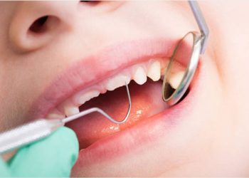 How Do Cavities Form and What Are the Most Effective Treatments for Them?
