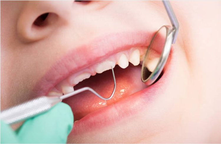 How Do Cavities Form and What Are the Most Effective Treatments for Them?