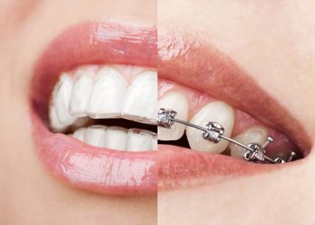 What Are the Latest Developments in Orthodontics? How Do Orthodontics Change Traditional Braces?