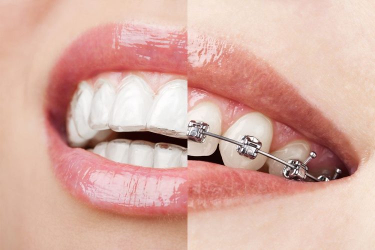 What Are the Latest Developments in Orthodontics? How Do Orthodontics Change Traditional Braces?