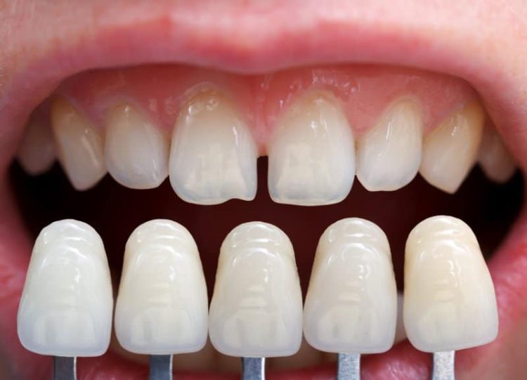 What Dental Issues Can Porcelain Veneers Solve? Are the Results Long-Lasting?