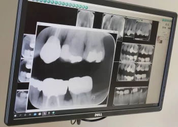 Can Digital X-rays Improve the Accuracy of Diagnosing Cavities?
