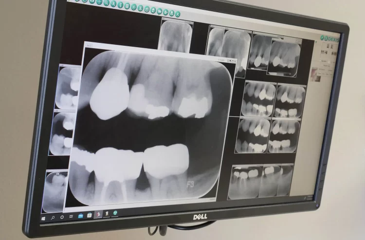 Can Digital X-rays Improve the Accuracy of Diagnosing Cavities?