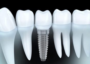 Recent Advancements in Dental Implant Technology and How They Improve Treatment Outcomes