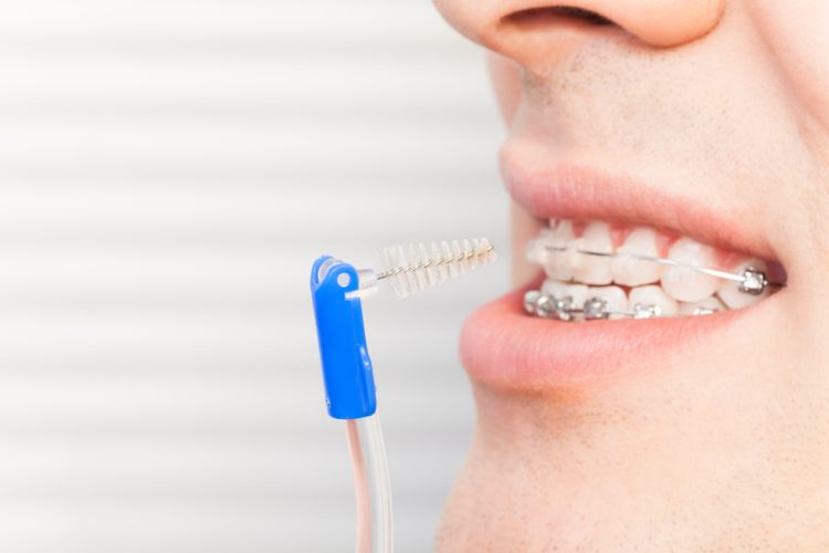 Floss vs. Interdental Brushes: Which Is Better for Your Oral Hygiene?