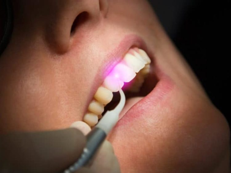 How Do Laser Teeth Cleanings Work? The High-Tech Way to Keep Your Teeth Sparkling
