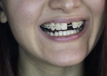 How to Restore Function and Aesthetics of Missing Teeth with Modern Treatment Options?