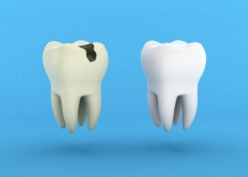What Are the Early Symptoms of Cavities? How to Effectively Prevent and Treat Them?