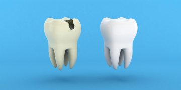 What Are the Early Symptoms of Cavities? How to Effectively Prevent and Treat Them?