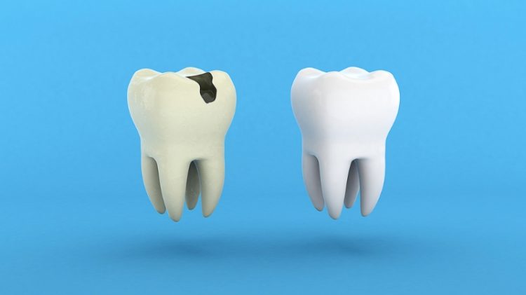 What Are the Early Symptoms of Cavities? How to Effectively Prevent and Treat Them?