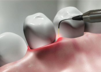 Laser Dentistry: Does It Harm Teeth? Common Misconceptions and The Truth