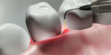 Laser Dentistry: Does It Harm Teeth? Common Misconceptions and The Truth
