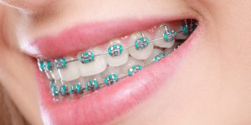Are Clear Aligners Truly Better Than Traditional Braces, or Does It Depend on Your Needs?