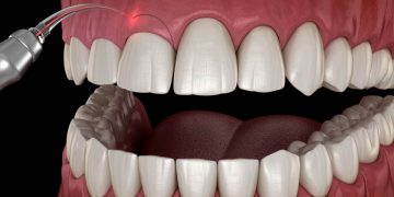 Lip and Gum Contouring in Cosmetic Dentistry: Is It Worth It?