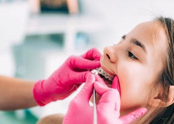 Do You Really Need Both Teeth Whitening and Straightening to Achieve the Perfect Smile?