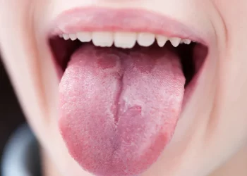 What Is Your Tongue Trying to Tell You About Your Health?