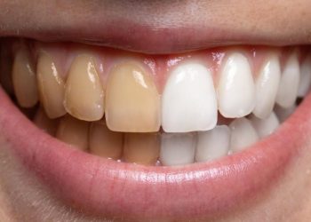 Tea, Coffee, and Oral Staining: How to Minimize Damage