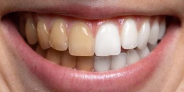 Tea, Coffee, and Oral Staining: How to Minimize Damage