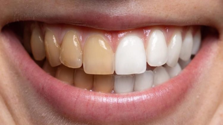 Tea, Coffee, and Oral Staining: How to Minimize Damage