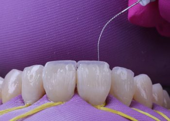 Is Tooth Bonding the Minimally Invasive Cosmetic Fix You’ve Been Looking For?