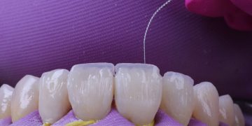 Is Tooth Bonding the Minimally Invasive Cosmetic Fix You’ve Been Looking For?