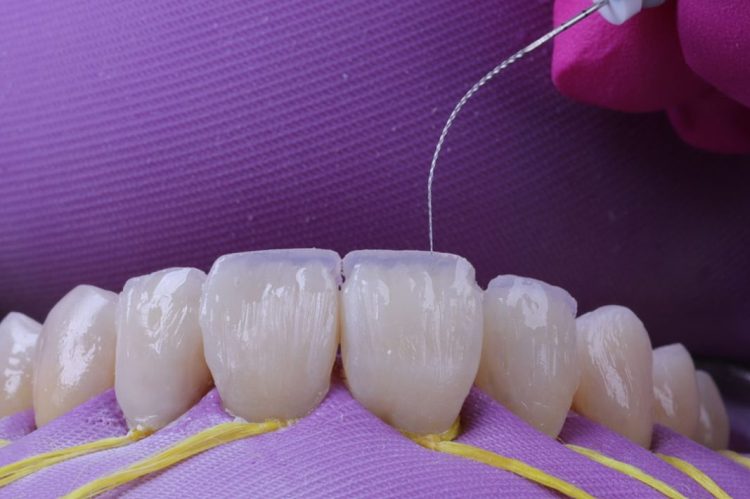 Is Tooth Bonding the Minimally Invasive Cosmetic Fix You’ve Been Looking For?