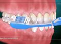 Are You Damaging Your Gums While Brushing? Common Brushing Mistakes Explained